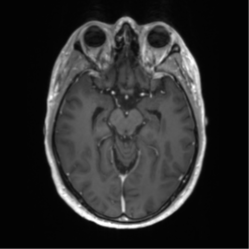 Acute disseminated encephalomyelitis (ADEM) (Radiopaedia 65319-74350 Axial T1 C+ 22).png