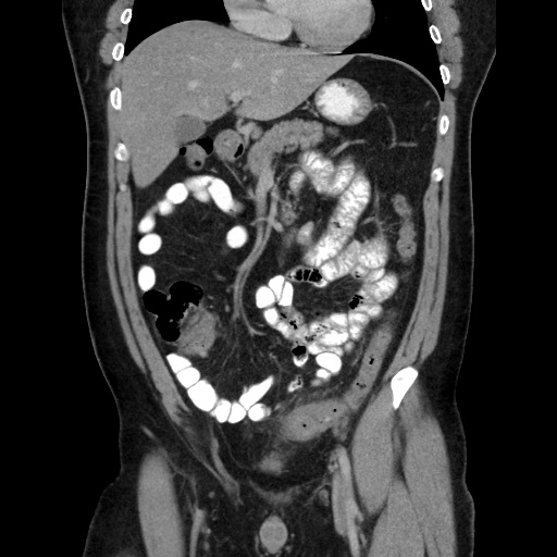 Acute diverticulitis with localized perforation (Radiopaedia 41296-44113 Coronal C+ portal venous phase 27).jpg