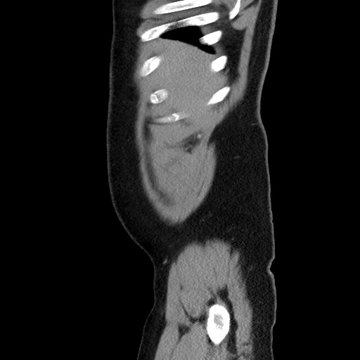 Acute diverticulitis with localized perforation (Radiopaedia 41296-44113 Sagittal C+ portal venous phase 13).jpg
