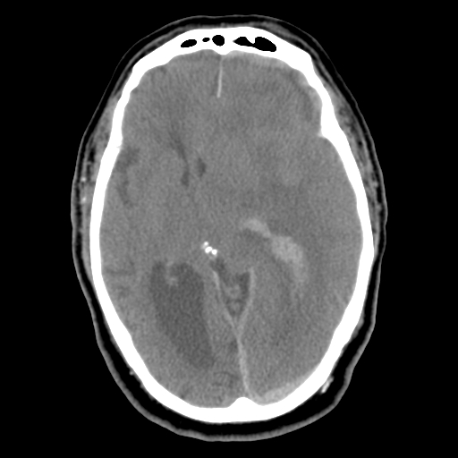 Acute hemorrhagic stroke (Radiopaedia 17507-17223 Axial non-contrast 24).jpg