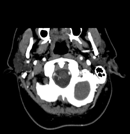 Acute internal carotid artery dissection (Radiopaedia 53541-59630 Axial C+ arterial phase 5).jpg