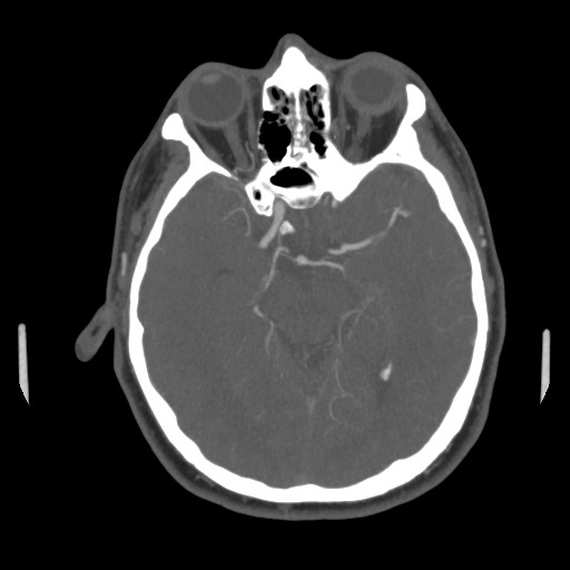 File:Acute internal carotid artery dissection (Radiopaedia 53541-59630 D 33).jpg