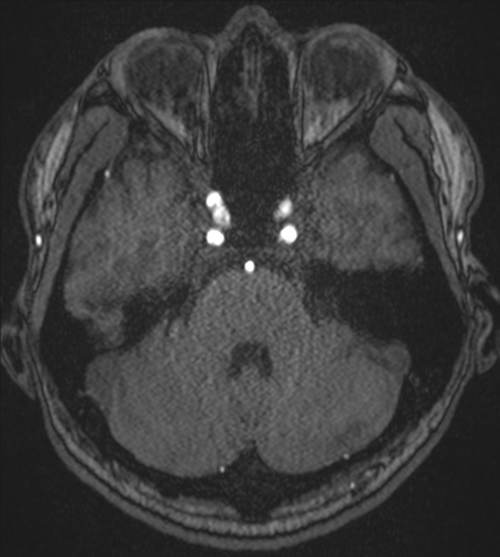 Acute left middle cerebral artery territory infarct with clot retrieval (Radiopaedia 47732-52433 Axial MRA 17).png