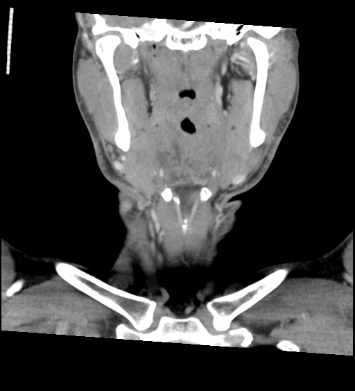 Acute longus colli calcific tendinitis (Radiopaedia 72495-83036 Coronal C+ arterial phase 22).jpg