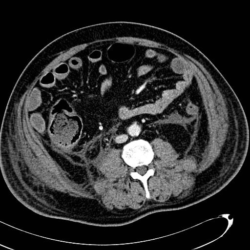 File:Acute pancreatic necrosis (Radiopaedia 13560-13486 Axial C+ portal venous phase 92).jpg