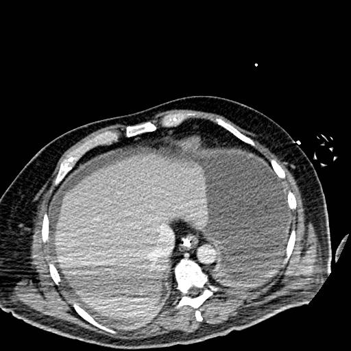 File:Acute pancreatic necrosis (Radiopaedia 13560-18501 Axial C+ portal venous phase 9).jpg