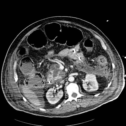 File:Acute pancreatic necrosis (Radiopaedia 13560-18502 Axial C+ portal venous phase 34).jpg