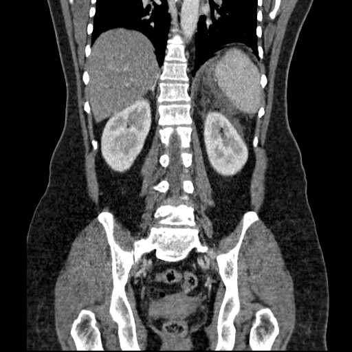 File:Acute pancreatitis (Radiopaedia 20829-20744 Coronal C+ portal venous phase 39).jpg