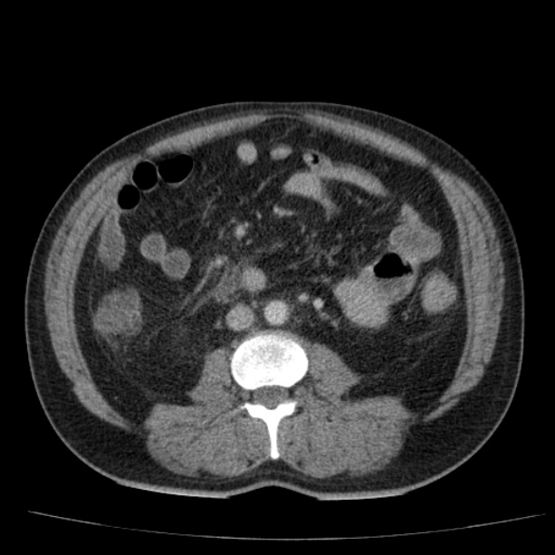 Acute pancreatitis (Radiopaedia 26663-26813 Axial C+ portal venous phase 48).jpg