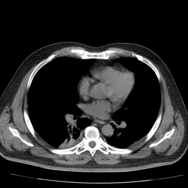 Acute pancreatitis (Radiopaedia 26663-26813 Axial non-contrast 5).jpg