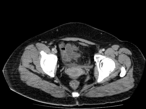 File:Acute pancreatitis (Radiopaedia 69236-79012 Axial C+ portal venous phase 84).jpg