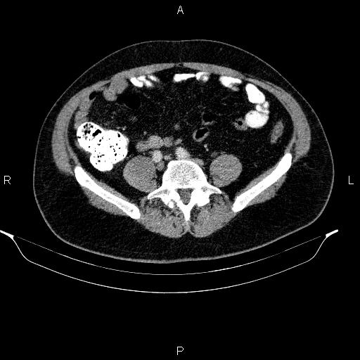 File:Acute pancreatitis (Radiopaedia 85390-101010 Axial C+ portal venous phase 74).jpg