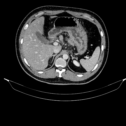 File:Acute pancreatitis (Radiopaedia 87428-103757 Axial C+ portal venous phase 31).jpg