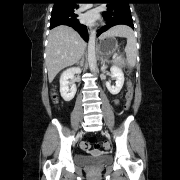 Acute pancreatitis - Balthazar C (Radiopaedia 26569-26714 Coronal C+ portal venous phase 41).jpg