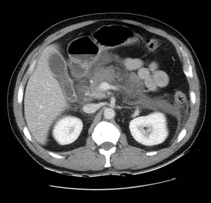 Acute pancreatitis - Balthazar E (Radiopaedia 23080-23110 Axial C+ portal venous phase 23).jpg