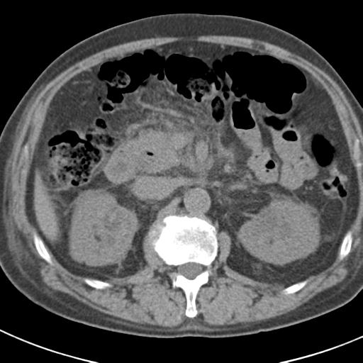 File:Acute pancreatitis and walled-off necrosis (Radiopaedia 29888-30403 Axial non-contrast 26).jpg