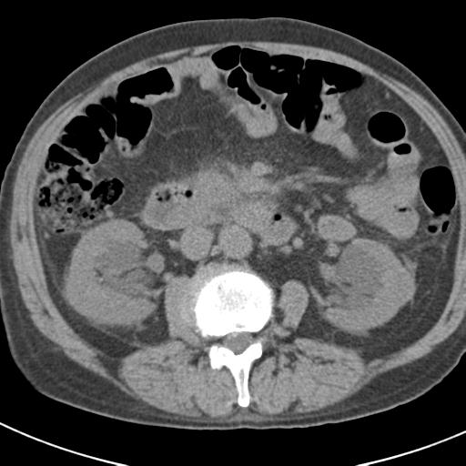 File:Acute pancreatitis and walled-off necrosis (Radiopaedia 29888-30403 Axial non-contrast 33).jpg