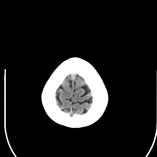 File:Acute pontine infarct from vertebral artery dissection (Radiopaedia 34111-35369 Axial non-contrast 29).png