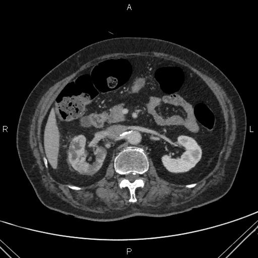 File:Acute renal artery occlusion (Radiopaedia 86586-102682 Axial C+ portal venous phase 29).jpg
