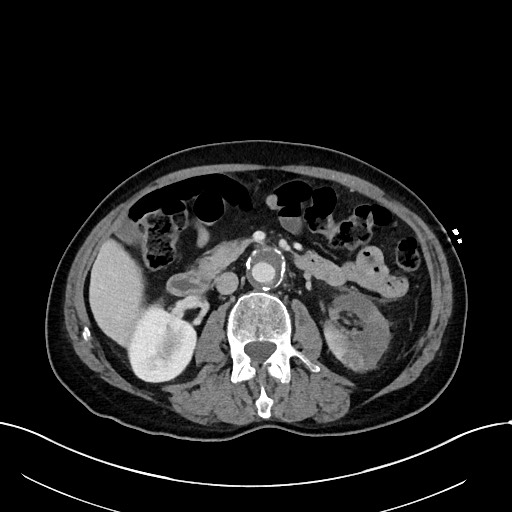 Acute renal infarction (Radiopaedia 59375-66736 Axial C+ portal venous phase 44).jpg
