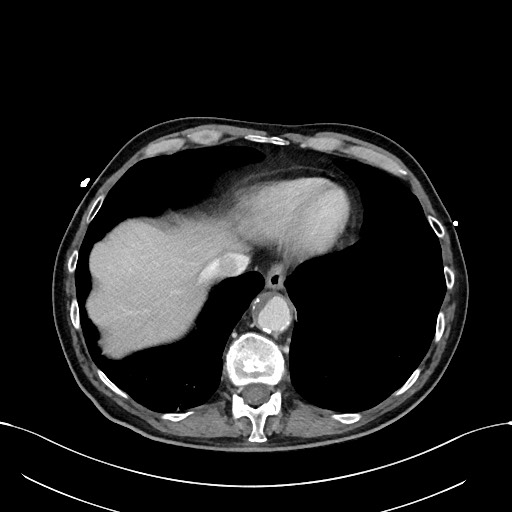 Acute renal infarction (Radiopaedia 59375-66736 Axial C+ portal venous phase 8).jpg