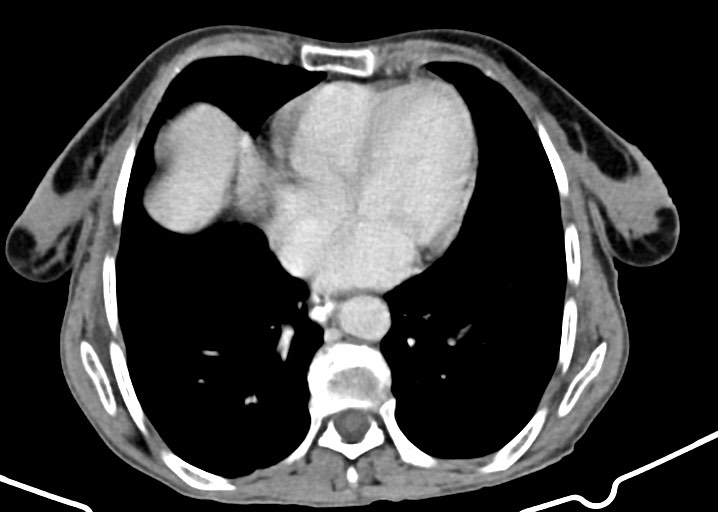 Acute small bowel (ileal) volvulus (Radiopaedia 71740-82139 Axial C+ portal venous phase 30).jpg
