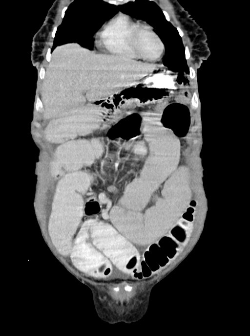 Acute small bowel (ileal) volvulus (Radiopaedia 71740-82139 Coronal C+ portal venous phase 27).jpg