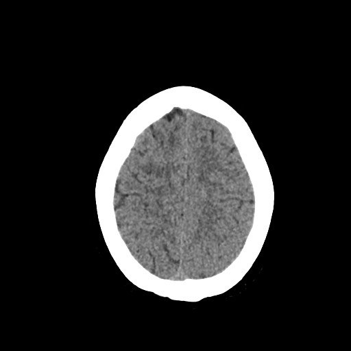 Acute subarachnoid hemorrhage and accessory anterior cerebral artery (Radiopaedia 69231-79008 Axial non-contrast 44).jpg