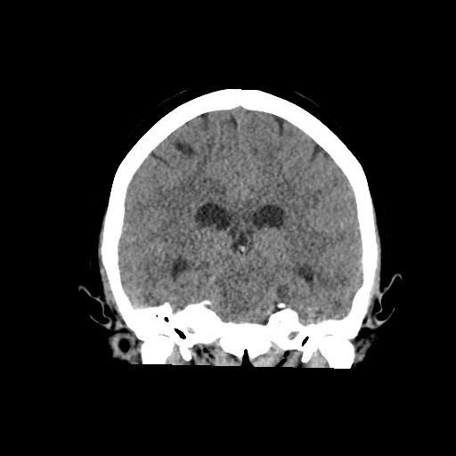Acute subarachnoid hemorrhage and accessory anterior cerebral artery (Radiopaedia 69231-79008 Coronal non-contrast 42).jpg