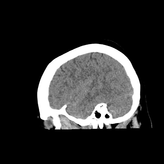 Acute subarachnoid hemorrhage and accessory anterior cerebral artery (Radiopaedia 69231-79008 Sagittal non-contrast 15).jpg