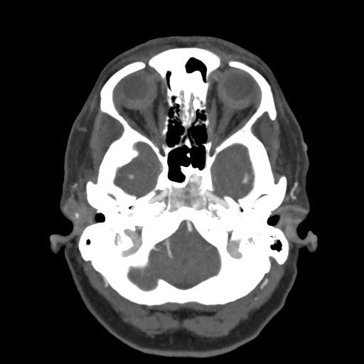 Acute subarachnoid hemorrhage and accessory anterior cerebral artery (Radiopaedia 69231-79009 D 15).jpg