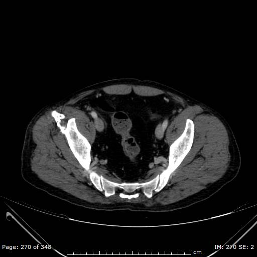 Acute superior mesenteric artery occlusion (Radiopaedia 43636-47060 Axial C+ portal venous phase 54).jpg