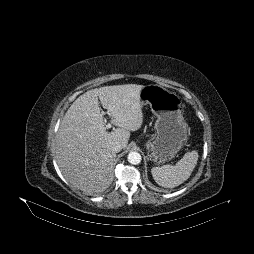 File:Acute superior mesenteric artery occlusion (Radiopaedia 51288-56960 Axial C+ arterial phase 15).jpg