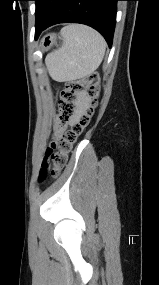 Acute uncomplicated appendicitis (Radiopaedia 61374-69304 Sagittal C+ portal venous phase 18).jpg