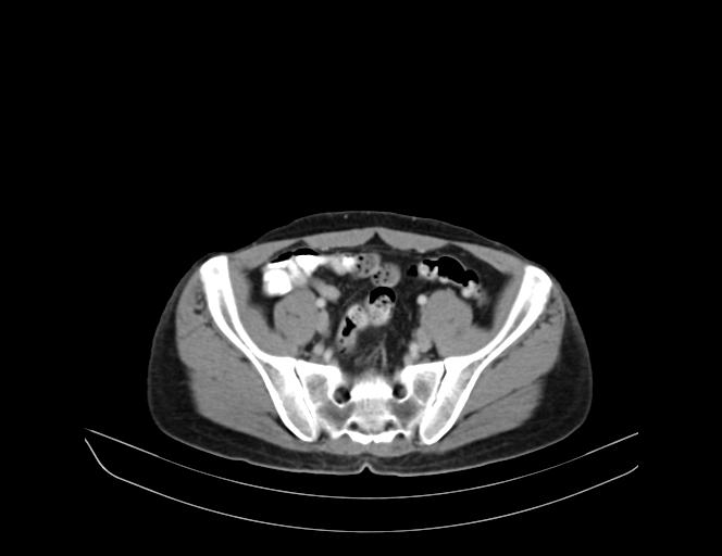 Addison disease (Radiopaedia 49318-54412 Axial C+ portal venous phase 62).jpg