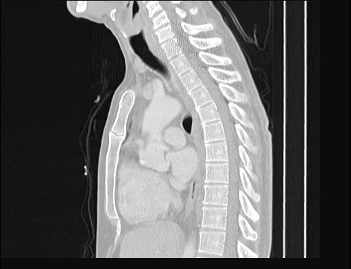 File:Addison disease (Radiopaedia 49318-54412 Sagittal lung window 32).jpg