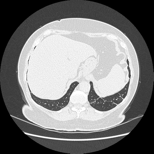 Adenocarcinoma in situ of lung (Radiopaedia 38685-40829 B 196).png