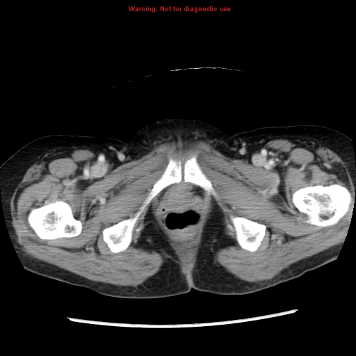 Adenocarcinoma of the colon (Radiopaedia 8191-9039 Axial liver window 78).jpg
