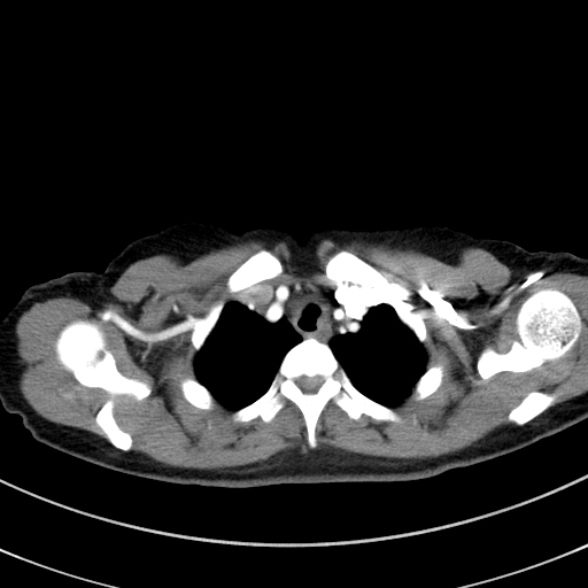Adenocystic carcinoma of the trachea (Radiopaedia 47677-52525 Axial C+ arterial phase 32).jpg