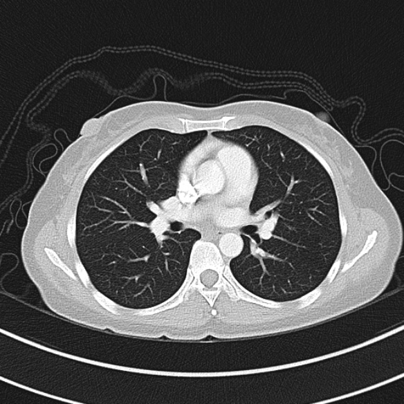 File:Adenocystic carcinoma of the trachea (Radiopaedia 47677-52525 Axial lung window 52).jpg
