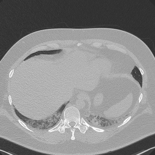Adenoid cystic carcinoma of the trachea (Radiopaedia 49042-54137 Axial lung window 288).jpg