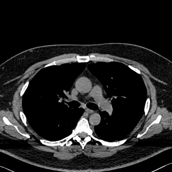 Adenoid cystic carcinoma of the trachea (Radiopaedia 49042-54137 Axial non-contrast 139).jpg