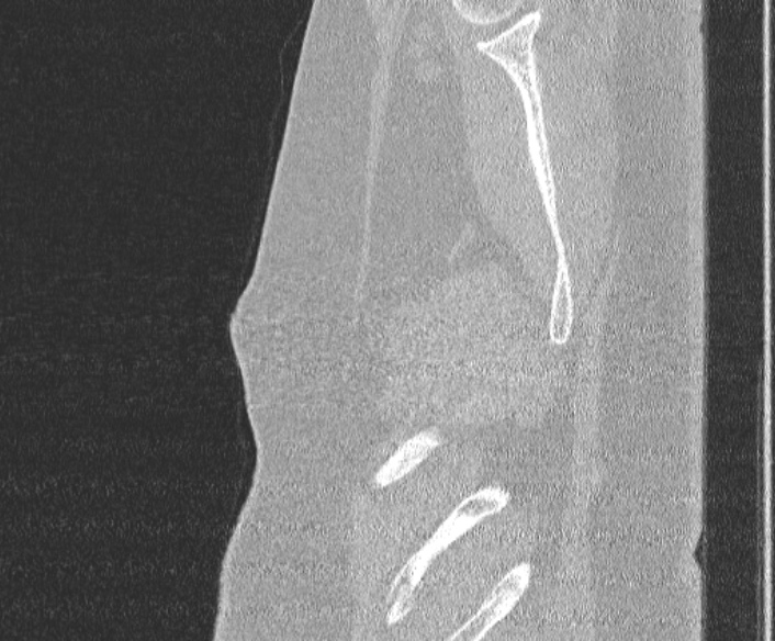 Adenoid cystic carcinoma of the trachea (Radiopaedia 49042-54137 Sagittal lung window 18).jpg