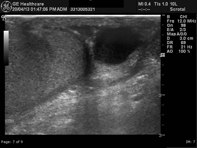 File:Adenomatoid tumor of the scrotum (Radiopaedia 22739-22762 E 1).jpg