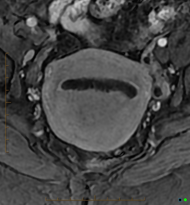Adenomyosis uterus with hematometra (Radiopaedia 45779-50011 Axial T1 C+ fat sat 27).jpg