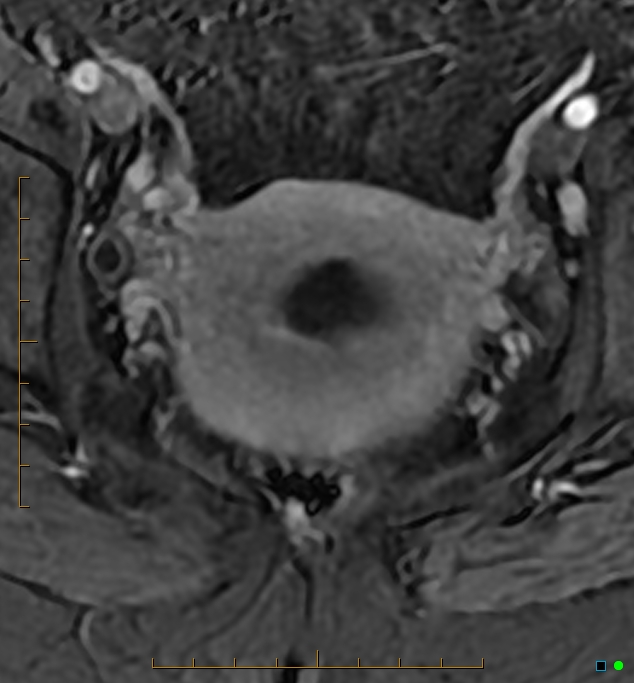 Adenomyosis uterus with hematometra (Radiopaedia 45779-50011 Axial T1 C+ fat sat 41).jpg