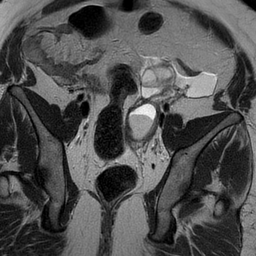 File:Adenomyosis within a didelphys uterus (Radiopaedia 70175-80215 Coronal T2 21).jpg