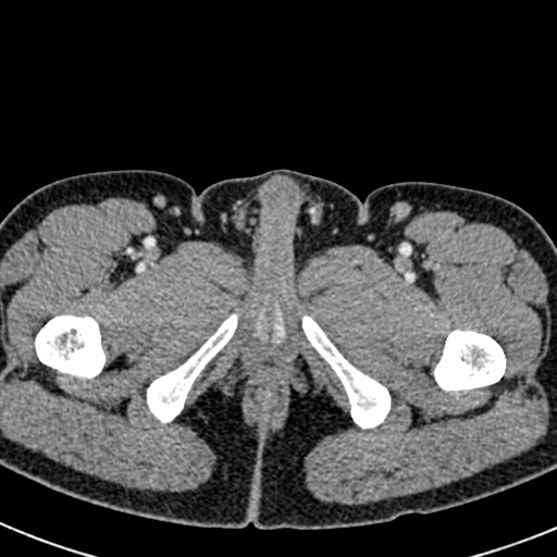 Adhesional small bowel obstruction (Radiopaedia 58900-66131 Axial C+ portal venous phase 58).jpg