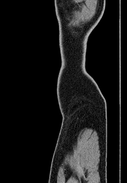 Adhesional small bowel obstruction (Radiopaedia 58900-66131 Sagittal C+ portal venous phase 4).jpg