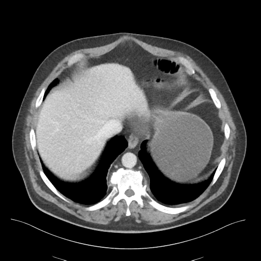 File:Adhesions within abdominal wall hernia (Radiopaedia 58283-65394 Axial C+ portal venous phase 13).png